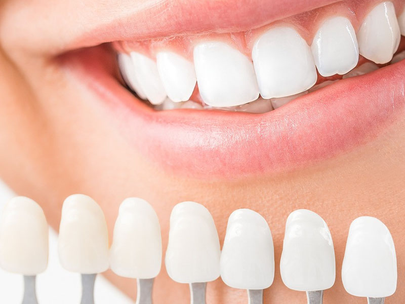 close up image of a smile showing teeth, alongside a range of veneers